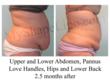 MyShape Lipo Launches Initiative to Fight Obesity with Large Volume Liposuction
